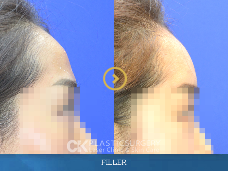 Before and After Filler