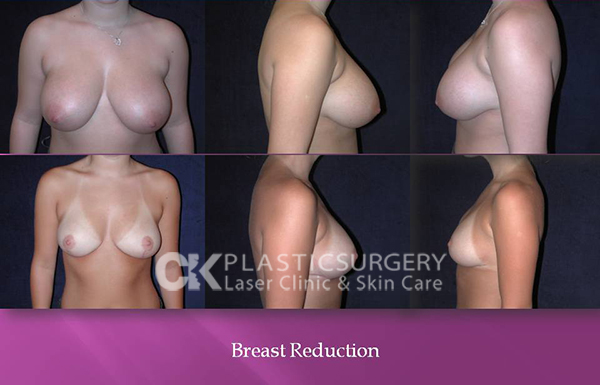 Breast Reduction in Los Angeles