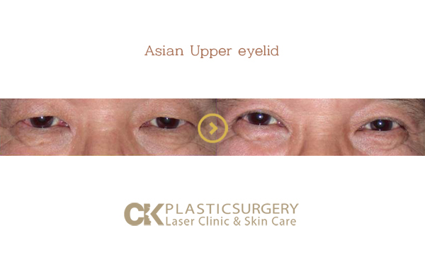 Asian Eyelid Surgery Los Angeles