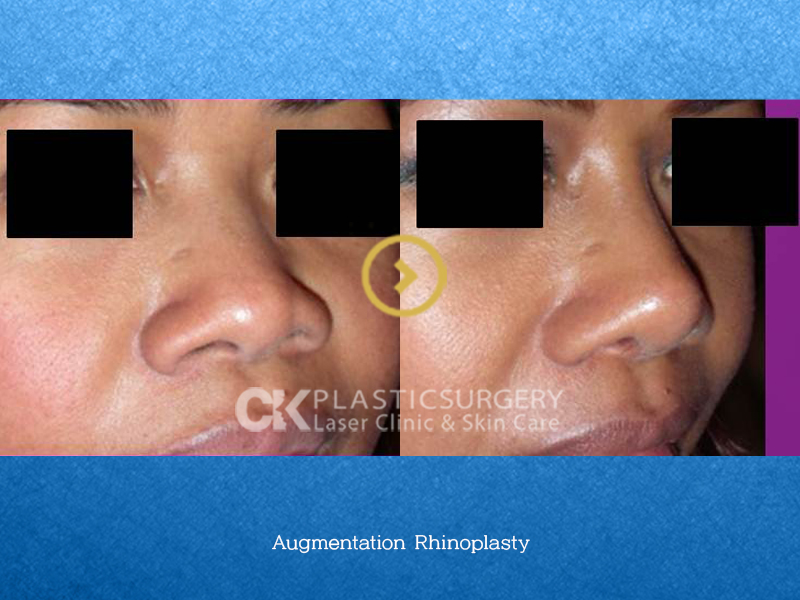 Rhinoplasty for a Flat Nose in CA