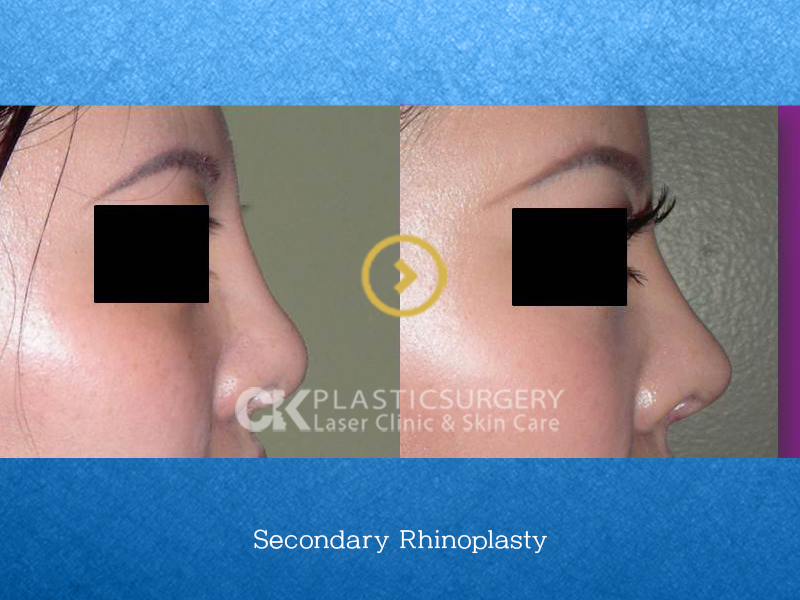 Rhinoplasty by Nose Type