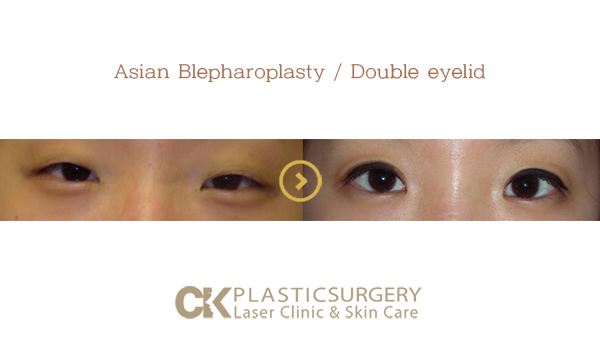 Asian Eyelid Surgeon
