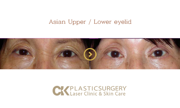 Lower Eyelid Surgery LA