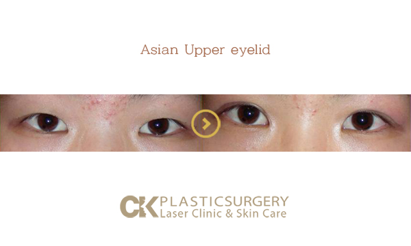 Upper Eyelid Wrinkle Surgery