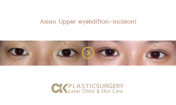 Asian Upper Eyelid