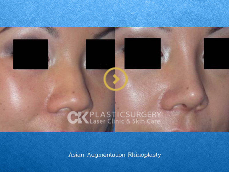Asian Augmentation Nose Surgery