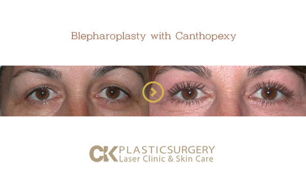 Canthoplasty Surgery LA