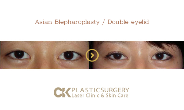Double Eyelid Surgery Los Angeles