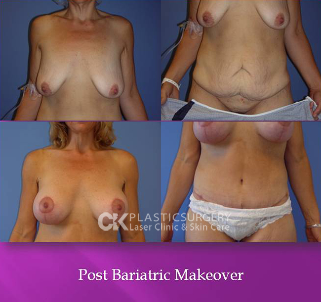 Post Bariatric Makeover