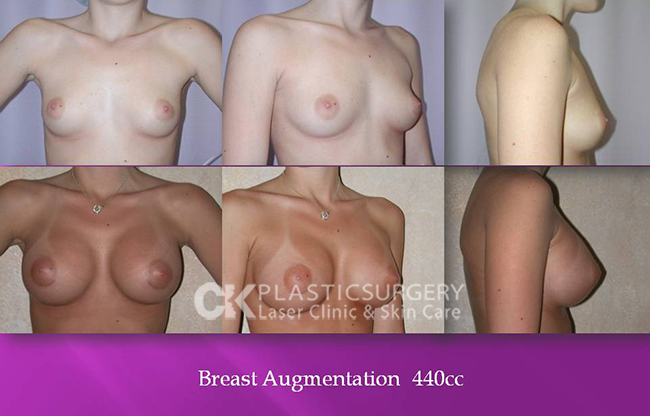 Breast Augmentation Los Angeles CA