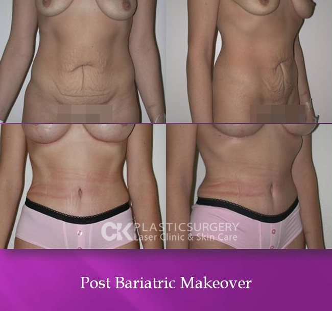 Post Bariatric Makeover Los Angeles