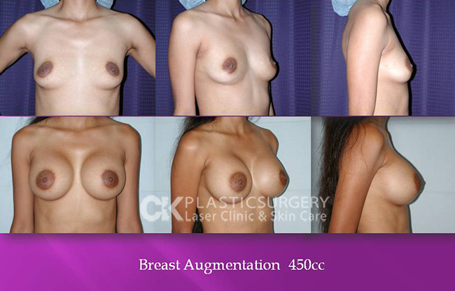 Breast Enlargement California