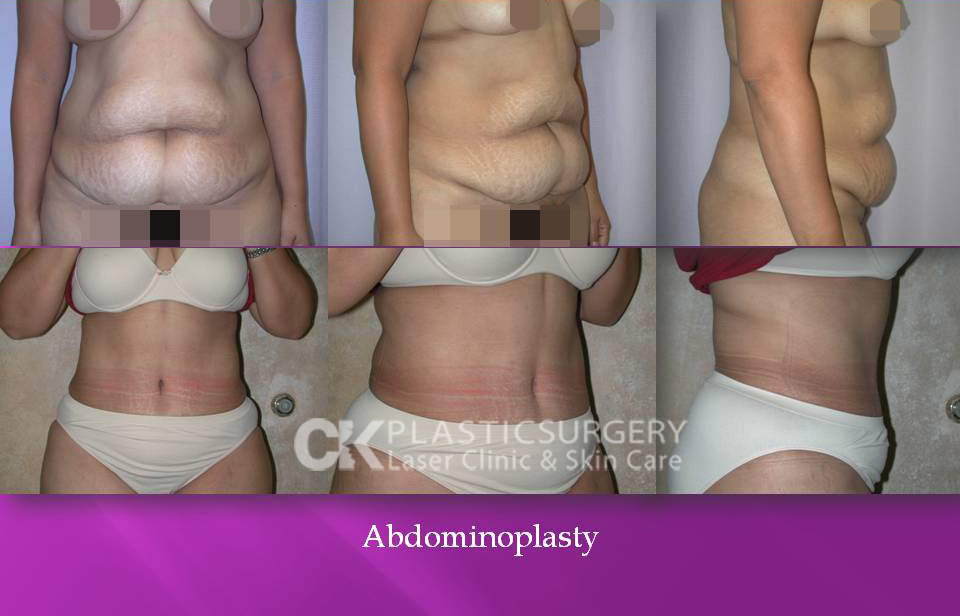 Abdominoplasty by Dr. Kim
