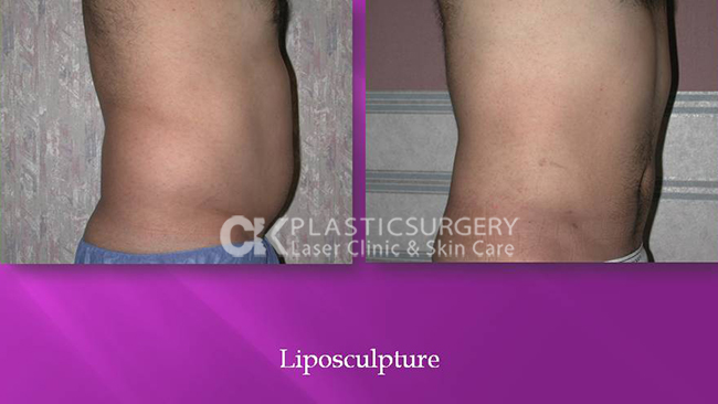 Liposuction in Costa Mesa
