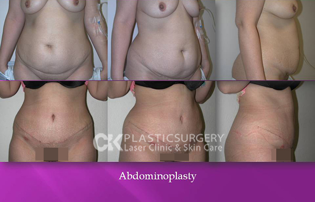 Abdominoplasty Plastic Surgery