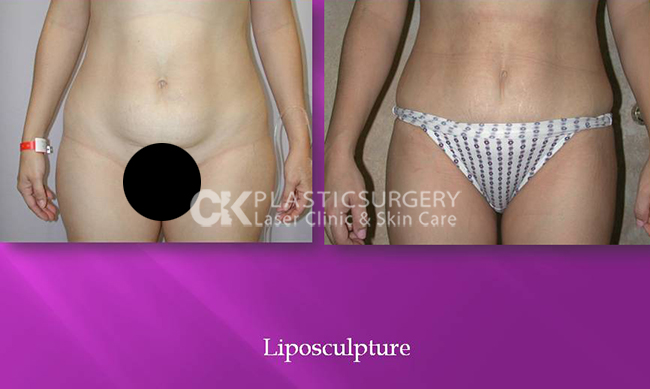 Liposuction Gallery