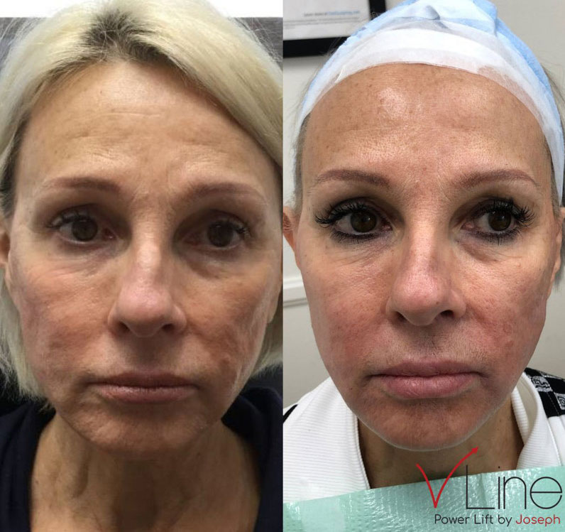 VLine Lift Before After