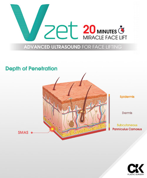 VZet Ultrasound Lifting